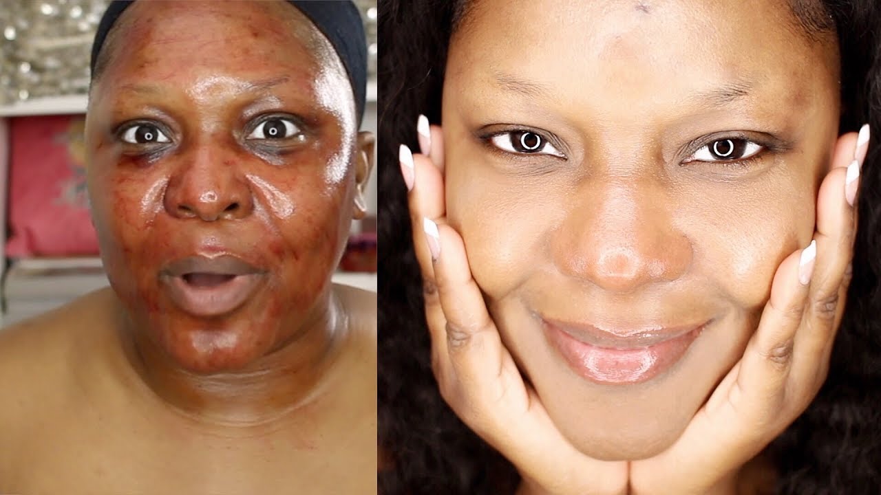 HOW I CLEARED UP MY SKIN USING THE ORDINARY | FINALLY! - YouTube