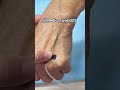 Iv cannula insertion in hand #medicoworld #doctor  #medicine #hospital #clinicalskills #mbbs #bhms