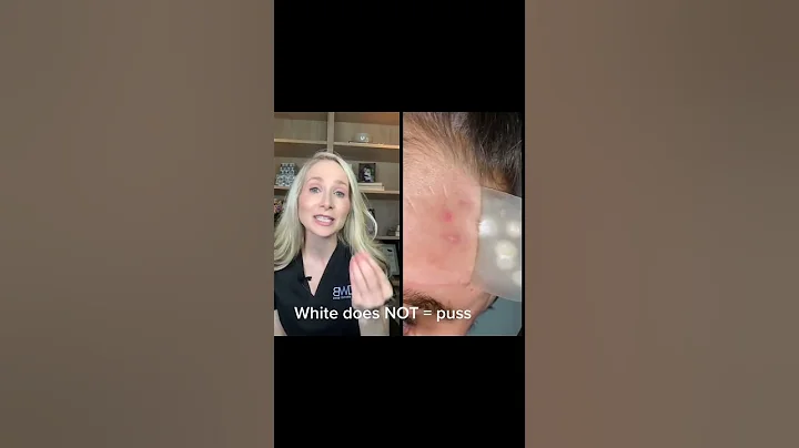 How do Hydrocolloid Patches Work? Dermatologist Explains #shorts