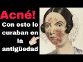 EL ACNÉ SU HISTORIA Y SUS TRATAMIENTOS A LO LARGO DEL TIEMPO