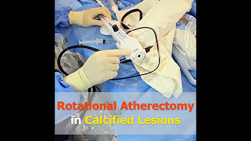 [SUB]Rotational Atherectomy in Calcified Lesions (RotaPro)