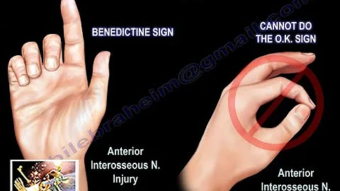 Anterior Interosseous Nerve Injury - Everything You Need To Know - Dr. Nabil Ebraheim - DayDayNews