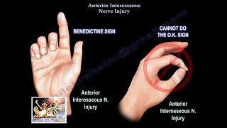 Anterior Interosseous Nerve Injury - Everything You Need To Know - Dr. Nabil Ebraheim