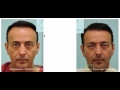 Hairline Correction & Temporal Point Hair Transplant Video Narration