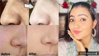 Clogged Pores, Blackheads, Whiteheads & Acne जड़ से खत्म करें सिर्फ 1 हफ्ते में  | 100% Results