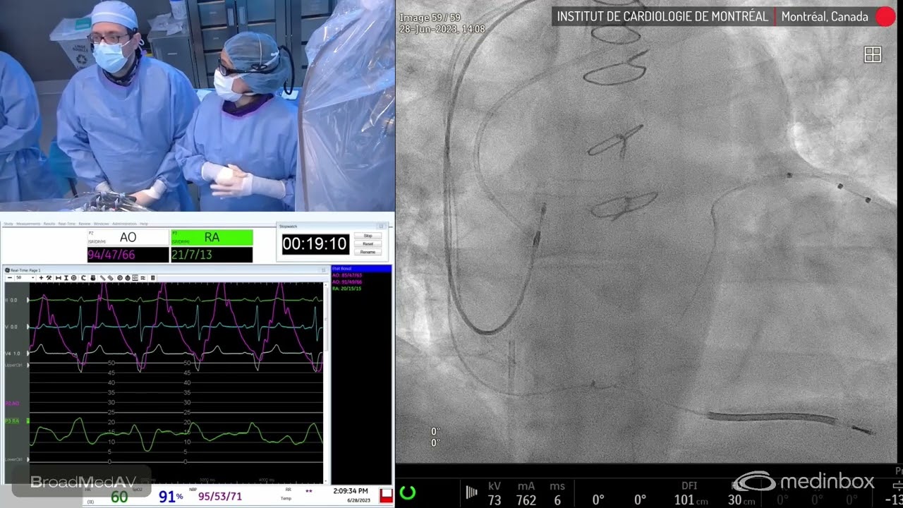 PA CardioMems Implantation In Patient with Descompensated HF And Elevated NT proBNP