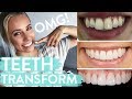 TEETH TRANSFORMATION | Porcelain Veneers | Before & After + Review