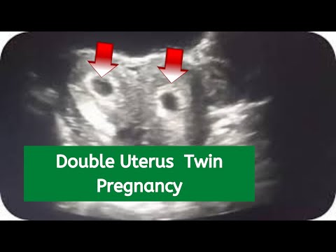 Video: Vyvolává dvourohá děloha dvojčata?