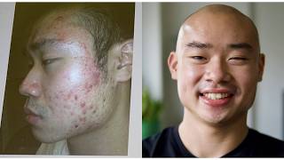 POV: you've struggled with acne for most of your life and finally overcame it