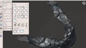 Fabricating a Zirconia Membrane for Ridge Augmentation Using Meshmixer