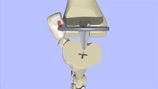 Knee Replacement Surgery