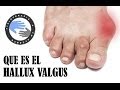 Que es un juanete o hallux valgus y por que salen