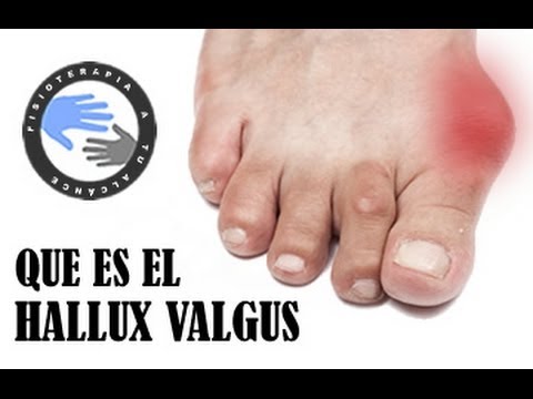 Video: ¿Por qué ocurre el hallux valgus?