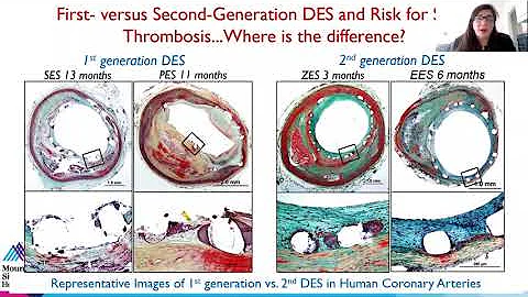 Antiplatelet Therapy in High Bleeding Risk Patients Following PCI, November 6,  2020