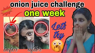 let's test onion juice on hair for one week|cured baldness|How to use Onion for hair growth|tamil