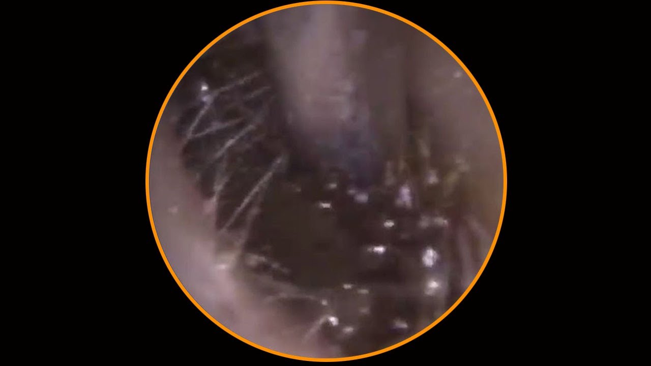 Tympanic membrane perforation and postoperative debridement for