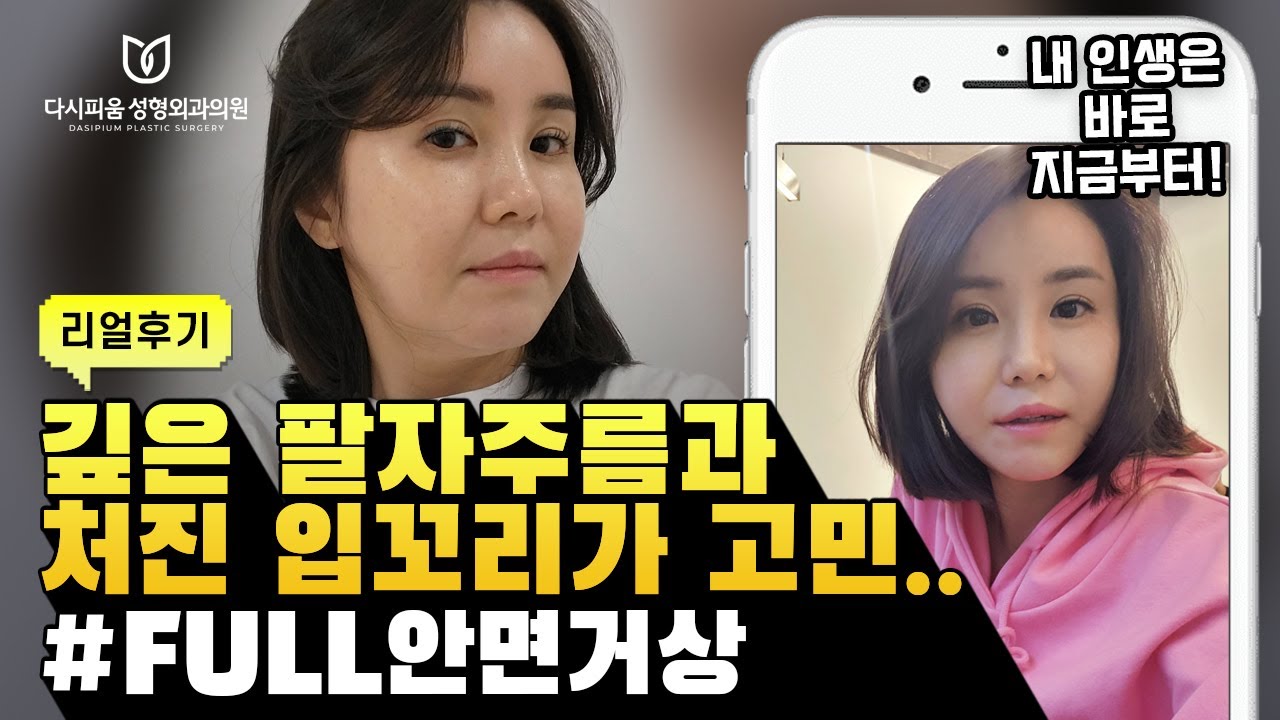 [日 SUB]깊은 팔자주름과 처진 입꼬리 고민!! 40대 초반 여성의 안면거상 후기!