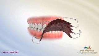 Orthodontic Retainer - Hawley