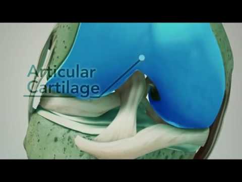 What Osteoarthritis 2017