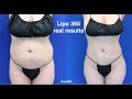 The Lipo 360 expert Beverly Hills Dr. Dennis Dass with before - after photos