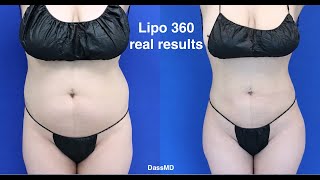 The Lipo 360 expert Beverly Hills Dr. Dennis Dass with before - after photos