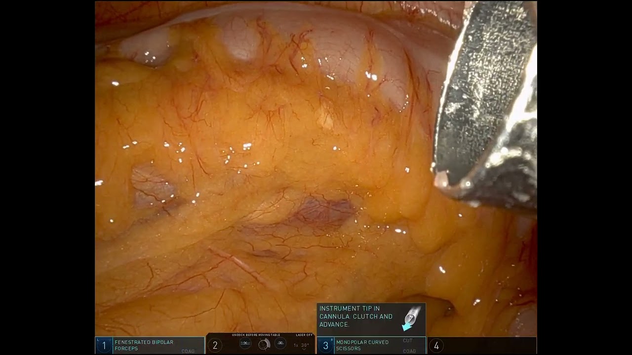 Robot assisted Partial Nephrectomy (RAPN), Lt.