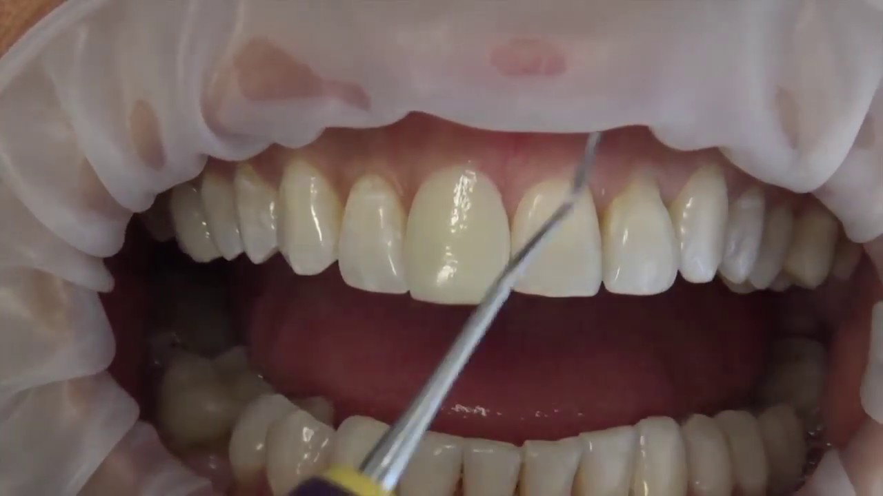 Rebel.dental mockup tutorial Vestibulo lingual position resective