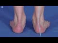 pie plano, valgo, equino , varo - Dr. Franklin Vargas - podologo