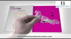Misaligned Teeth Correction Hyderabad | Orthodontic Treatment | Teeth Alignment