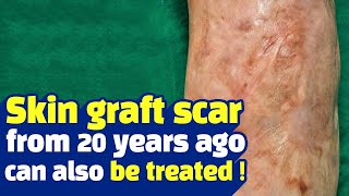 Skin graft scar from 20 years ago can also be treated!