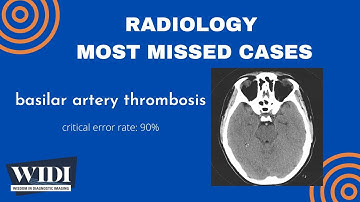 Most Missed Cases: Basilar Artery Thrombosis