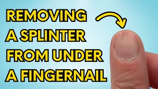 Removing a Splinter From Under a Fingernail | How to Pull Out a Sliver Stuck Under Your Fingernail