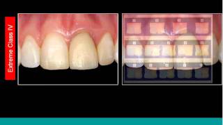 Anterior Composite Webinar & Demonstration