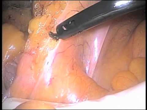 Hand-assisted Laparoscopic Low Anterior Resection for Rectal cancer