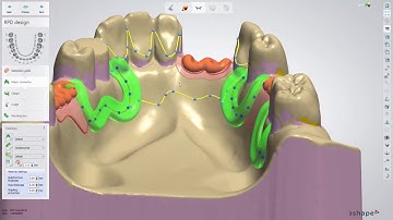 235 - Lower RPD Class III mod 2