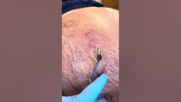 Dry needling rotator cuff  w/ Electrical Stimulation