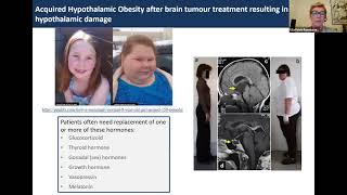 Hypothalamic Obesity Clinical Trials Panel