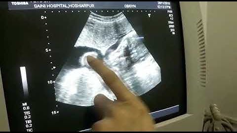 Lambda Sign to Determine Chorionicity