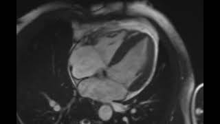 МРТ сердца в cine-режиме | функциональное изображение сердца в четырехкамерной проекции