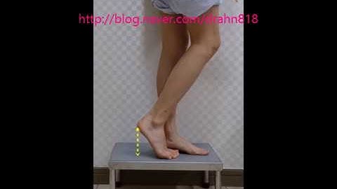 Equinus foot deformity correction after calf reduction surgery