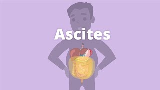 Cirrhosis – Ascites and pleural effusion