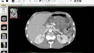 Gastric ulcer vs ulcerated gastric mass (Nelly Tan)