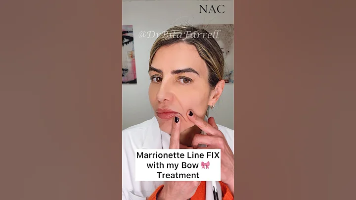 #marionettelines #marionettelinesfiller #fillertraining #drbitafarrell