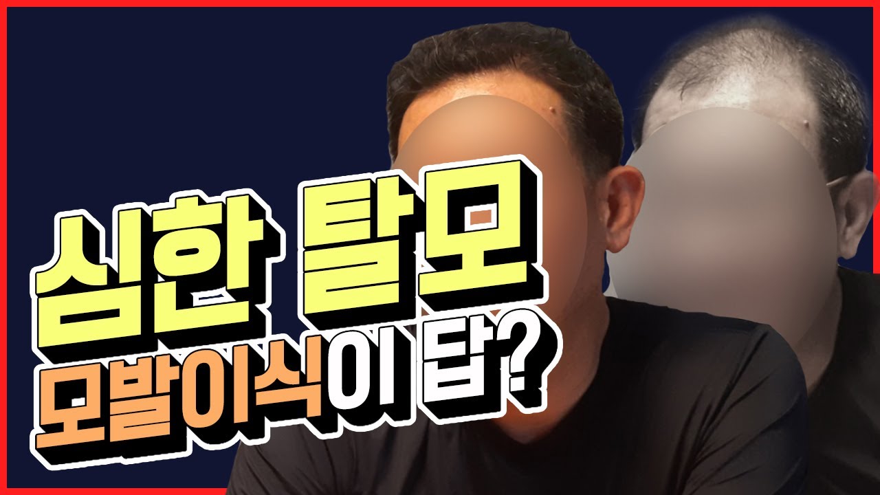 심한 남성형 탈모도 개선이 가능할까요?