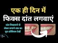 एक ही दिन में फिक्स दांत लगवाएं || Immediate Dental Implant ||#dentalimplants