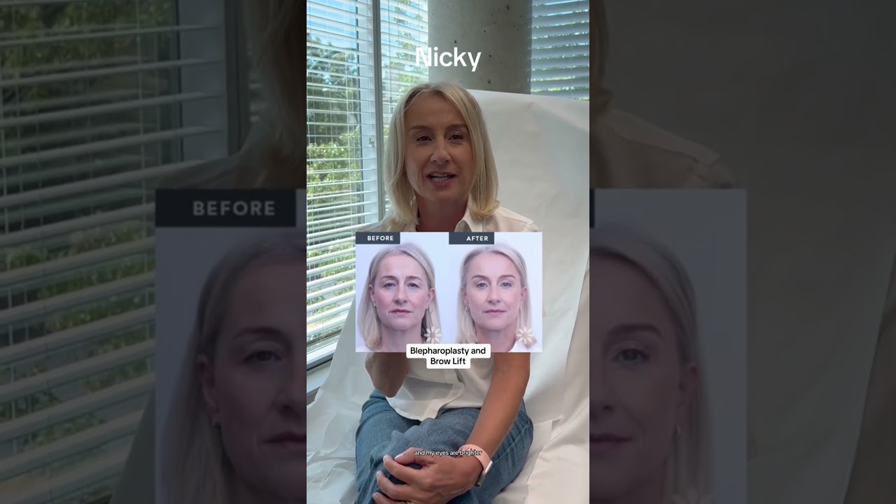 Patient Spotlights: Facial Surgery with Dr. Buonassisi | 8 West Clinic - Vancouver, BC