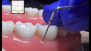 How to use periodontal probe? Periodontal probing technique for anterior and posterior teeth