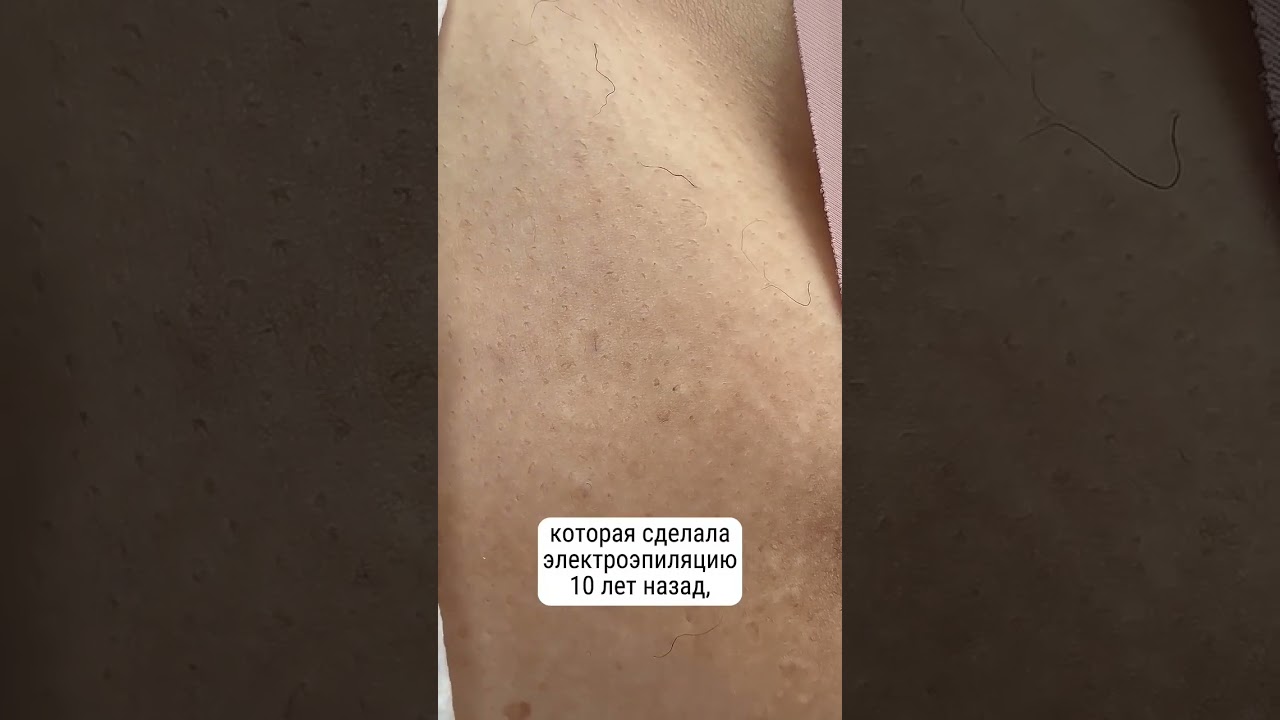 Электроэпиляция бикини. Результат спустя 10 лет! 