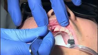 How To Design Flap To Recreate Original Soft Tissue For Anterior Tooth After Implant Placement
