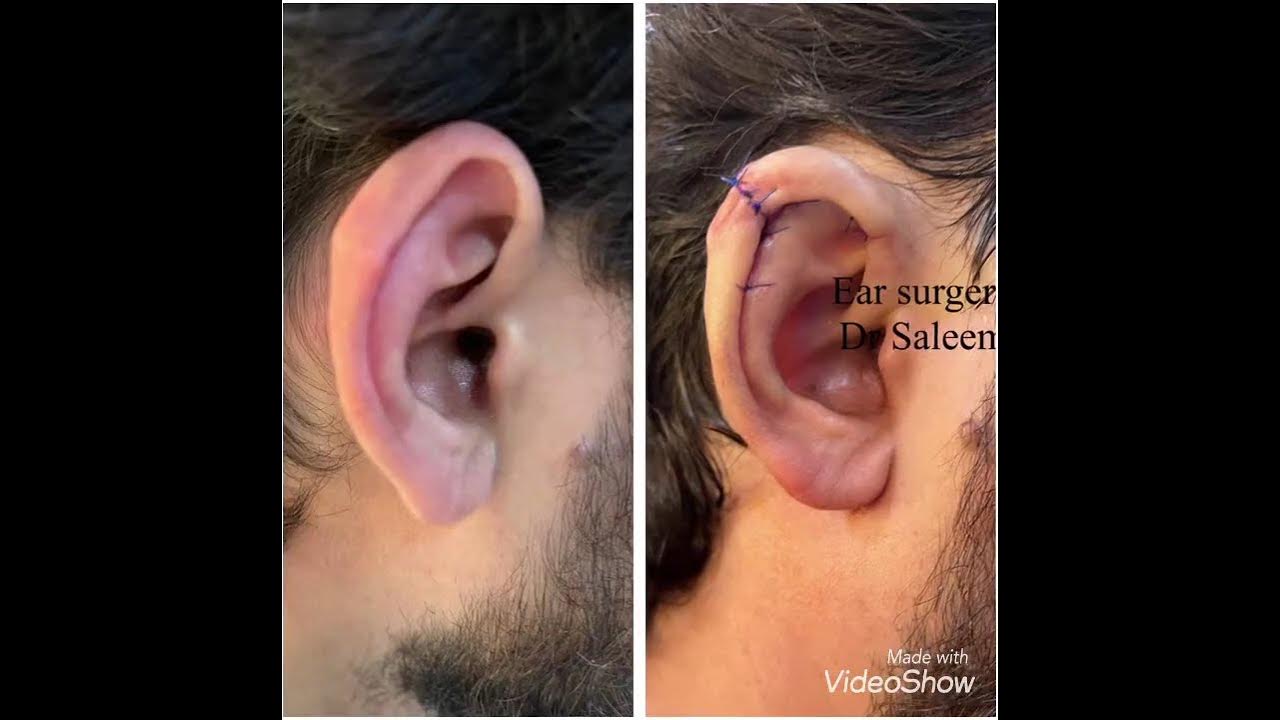 Ear reshaping surgery, bat ear correction YouTube
